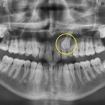 Impacted Canines