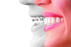 Sterling Heights Invisalign ,Warren Invisalign